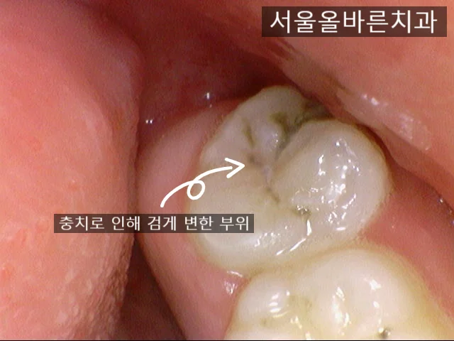 구리 매복 사랑니 발치는 어떻게 수술을 하나요? (구강악안면외과 전문의 진료 후기) - 초기 진단
