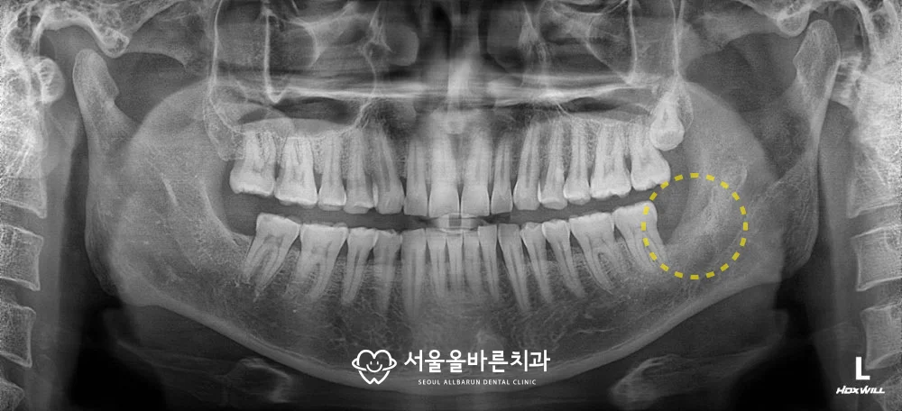 2019년 2월, 발치 7개월 후 파노라마 엑스레이