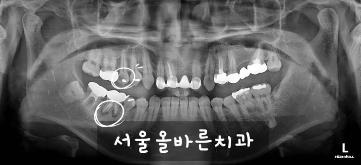 구리 어금니 임플란트, 염증 때문에 까다로운 케이스 - 초기 진단