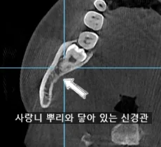 사랑니 발치 시 진행한 CT 촬영