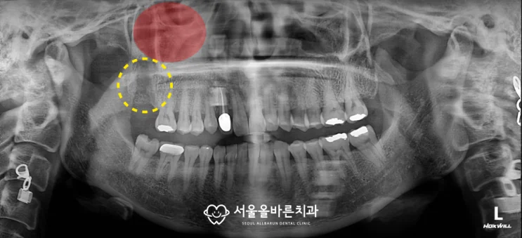 사랑니 및 어금니 발치 후 상태 광범위한 골 결손 발생