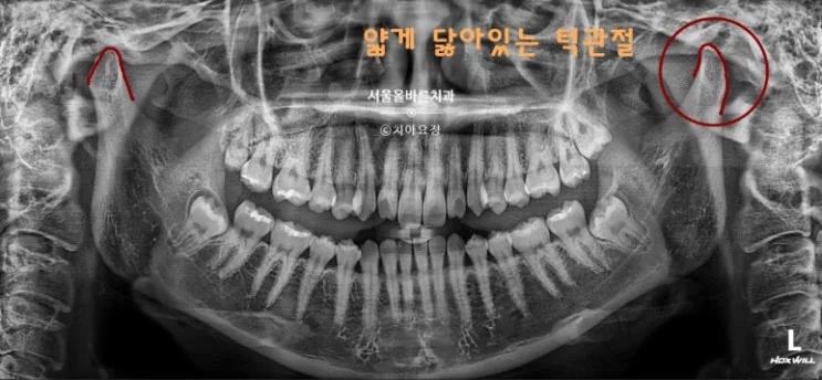 구리 수택동 턱관절 염증, 어떤 증상이 있을까요? - 턱에서 느껴지는 통증
