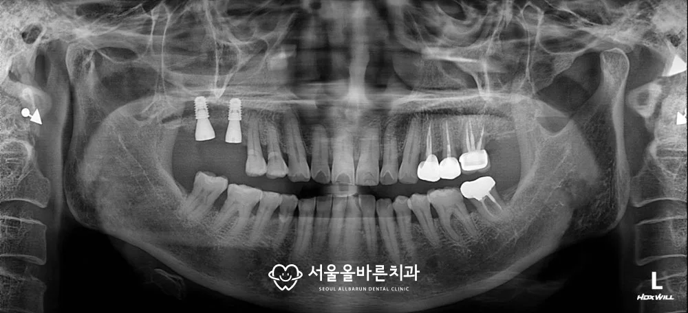 2024년 11월 파노라마 엑스레이, 뼈이식과 함께 다시 심은 임플란트