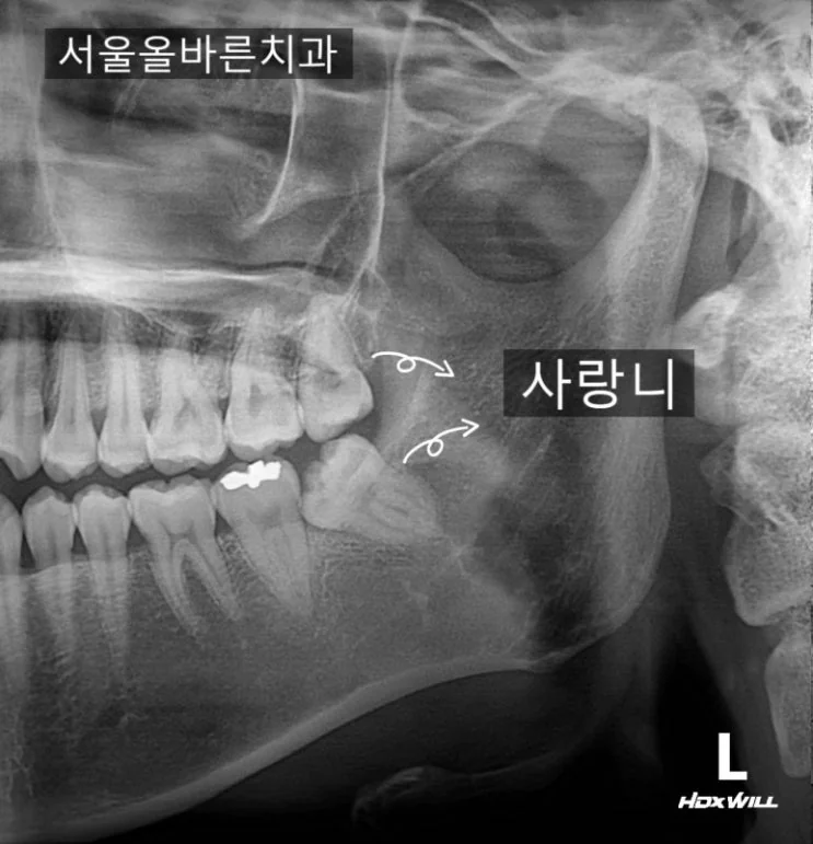 구리 매복 사랑니 발치는 어떻게 수술을 하나요? (구강악안면외과 전문의 진료 후기) - 초기 진단