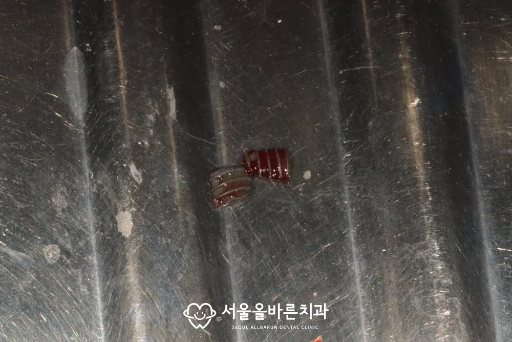 제거한 임플란트 파절편