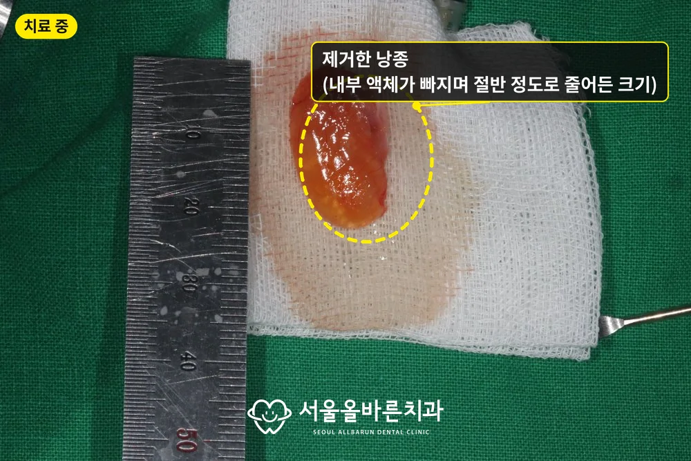 제거한 상악동 낭종, 내부 액체가 빠지며 크기가 절반 정도로 줄어든 상태