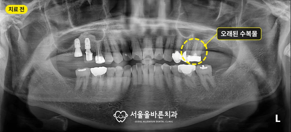 2024년 12월 파노라마 엑스레이, 오래된 수복물이 있던 왼쪽 위 어금니 표시