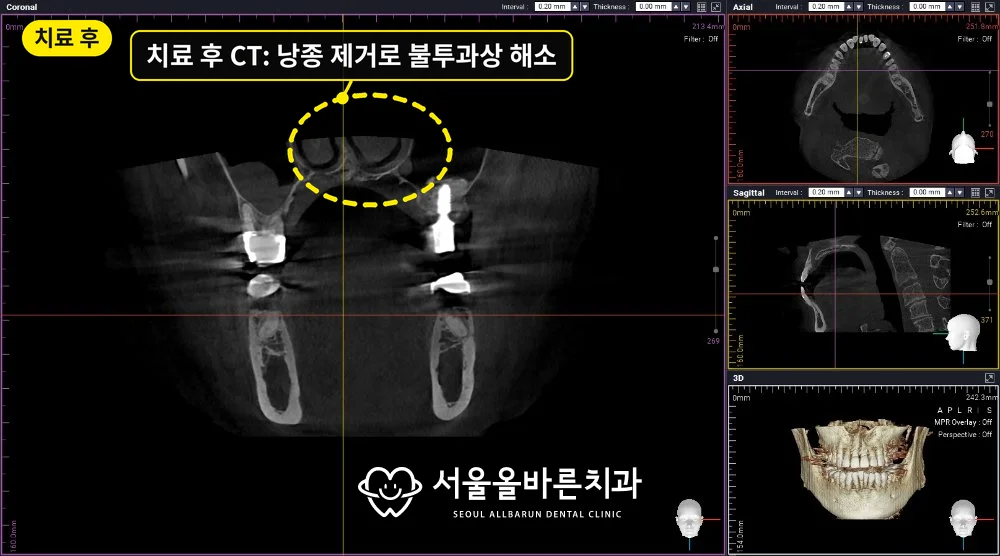치료 후 CT, 낭종을 제거해 왼쪽 상악동 불투과상이 해소된 모습