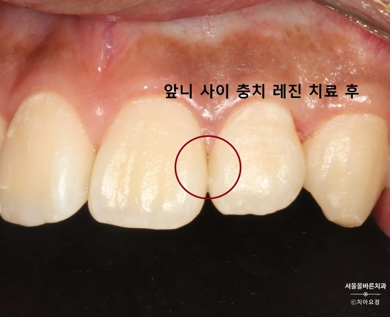 앞니 사이 충치, 레진 치료 후