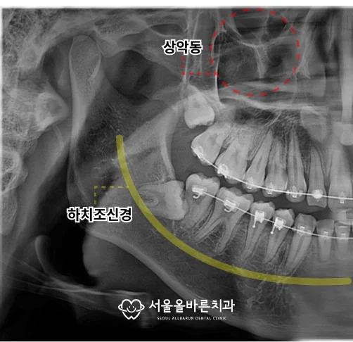 상악동과 하치조신경은 사랑니 발치에서도 중요하게 고려합니다