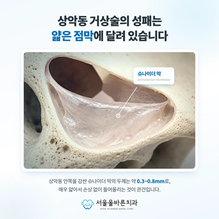 수택동 치과, 상악동거상 골이식 임플란트의 두 가지 방식 - 슈나이더막이란?