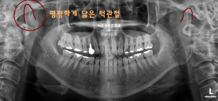 구리 수택동 턱관절 염증, 어떤 증상이 있을까요? - 턱에서 느껴지는 통증