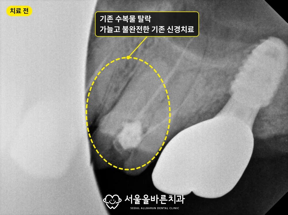 2025년 12월 엑스레이, 수복물이 빠진 어금니와 가늘고 불완전한 기존 신경치료