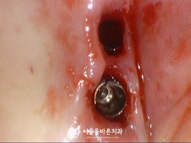 보철물을 제거한 뒤 드러난 임플란트 픽스처