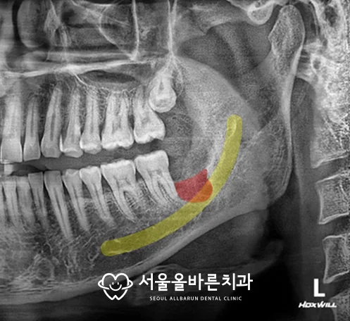 제거 직후 확대 사진, 발치 부위와 하치조신경관
