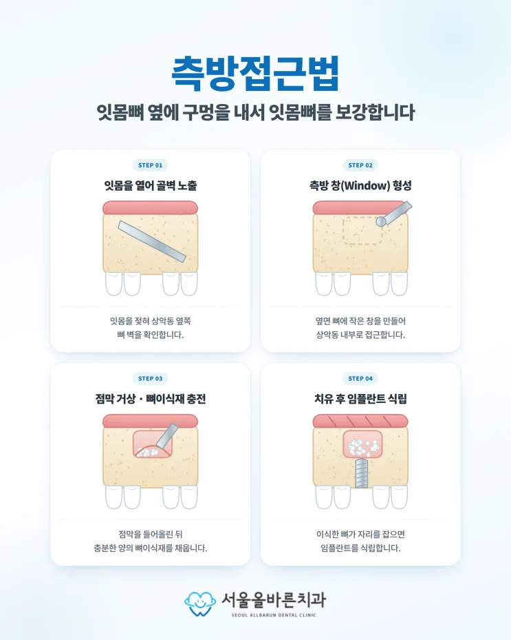 구리 어금니 임플란트, 치과 전문의가 생각하는 중요한 점 - 상악동거상술은 왜 할까요?