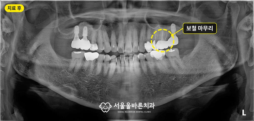 2026년 10월 검진 파노라마 엑스레이