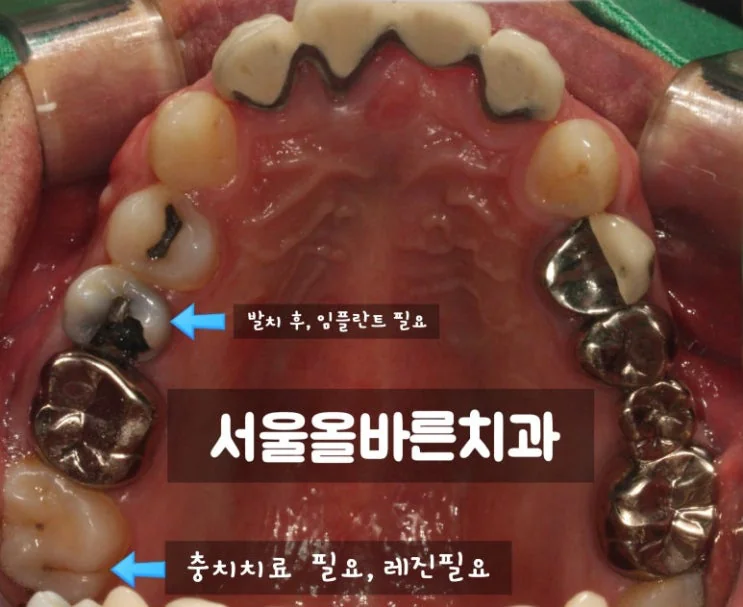 구리 어금니 임플란트, 염증 때문에 까다로운 케이스 - 초기 진단