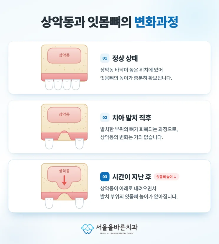 구리 어금니 임플란트, 치과 전문의가 생각하는 중요한 점 - 상악동거상술은 왜 할까요?