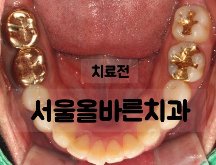 구리 어금니 임플란트, 염증 때문에 까다로운 케이스 - 치료 결과