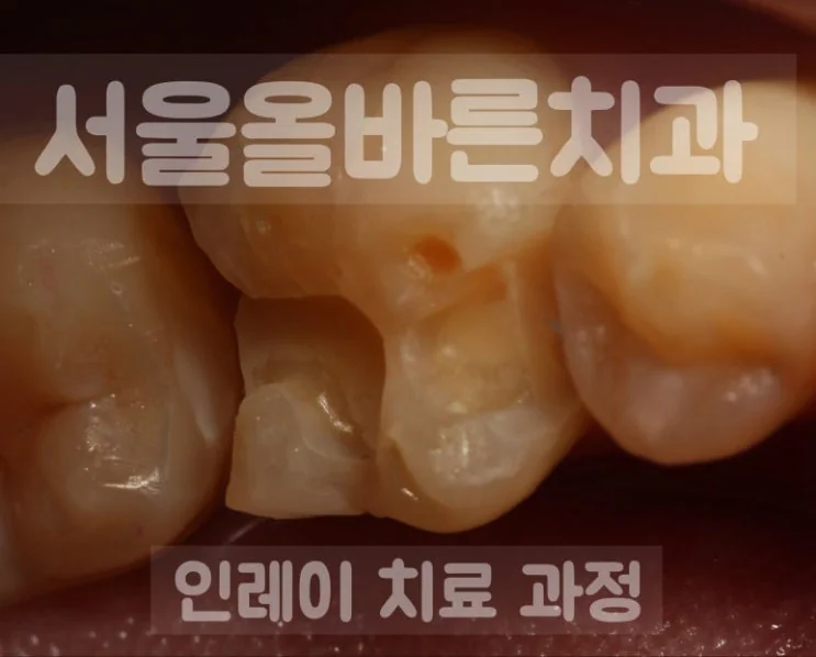 치아 사이 교합면 충치 삭제량이 많습니다
