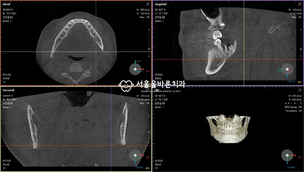 치료 전 CT 사진