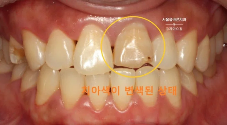 앞니의 변색된 치아 심미성 때문에 바로 치료를 받으십니다