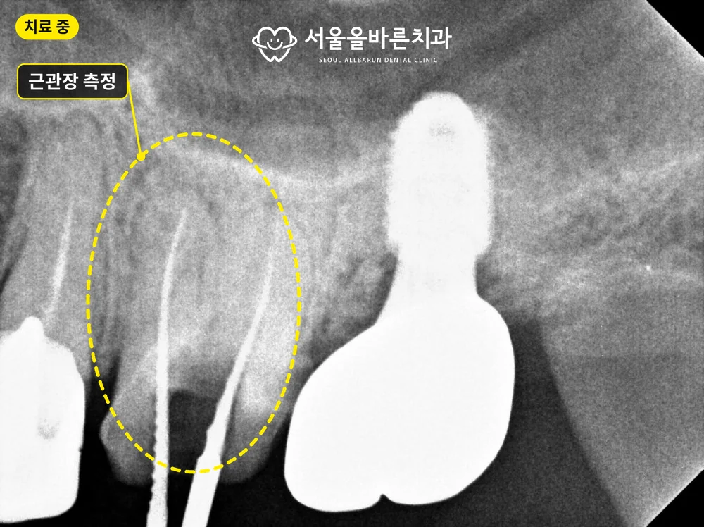 재신경치료 중 엑스레이, 근관장 측정