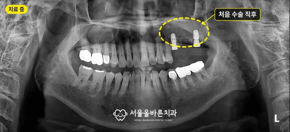 처음 수술 직후 파노라마, 위 왼쪽에 임플란트 두 개를 심은 모습