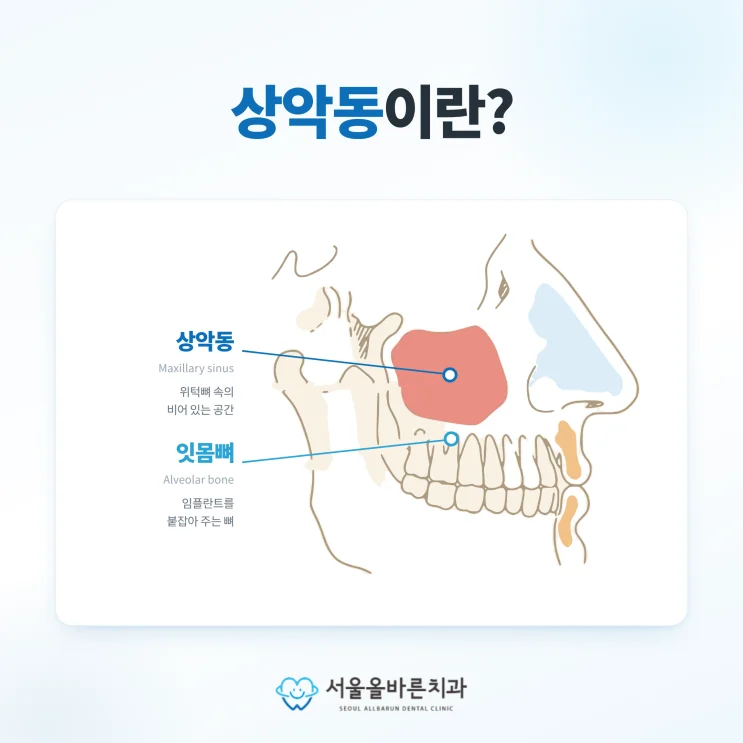 수택동 치과, 상악동거상 골이식 임플란트의 두 가지 방식 - 상악동을 확인하는 이유
