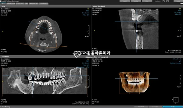 치아종·매복치 진단을 위한 3차원 CT 소견
