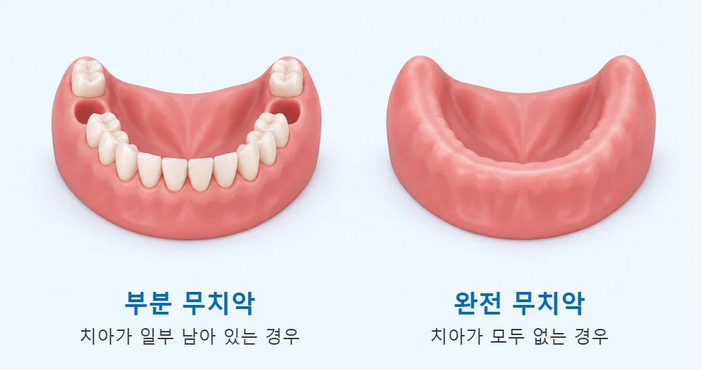 왼쪽은 치아가 일부 남아 있는 부분 무치악, 오른쪽은 치아가 모두 없는 완전 무치악을 비교한 그림
