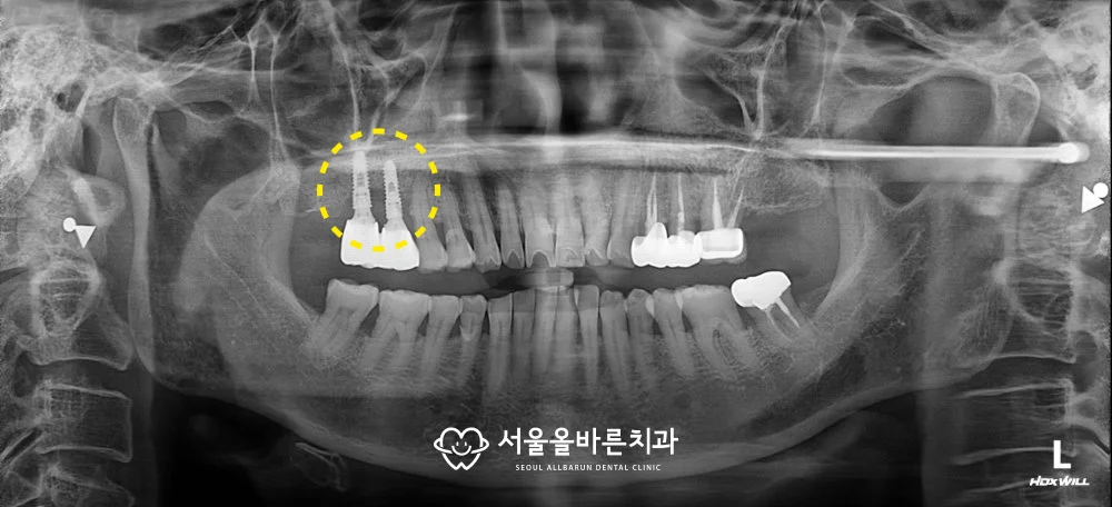 치료 전 파노라마 엑스레이, 오른쪽 위 어금니 임플란트 주변 골소실 부위 표시