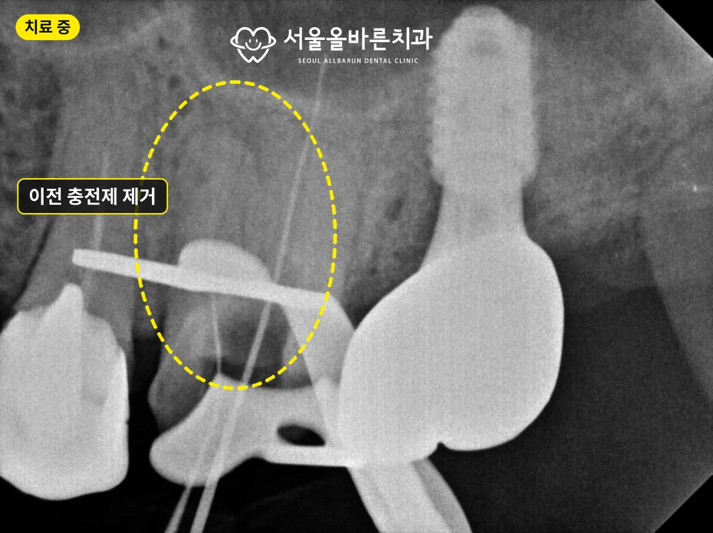 재신경치료 중 엑스레이, 이전 충전제 제거