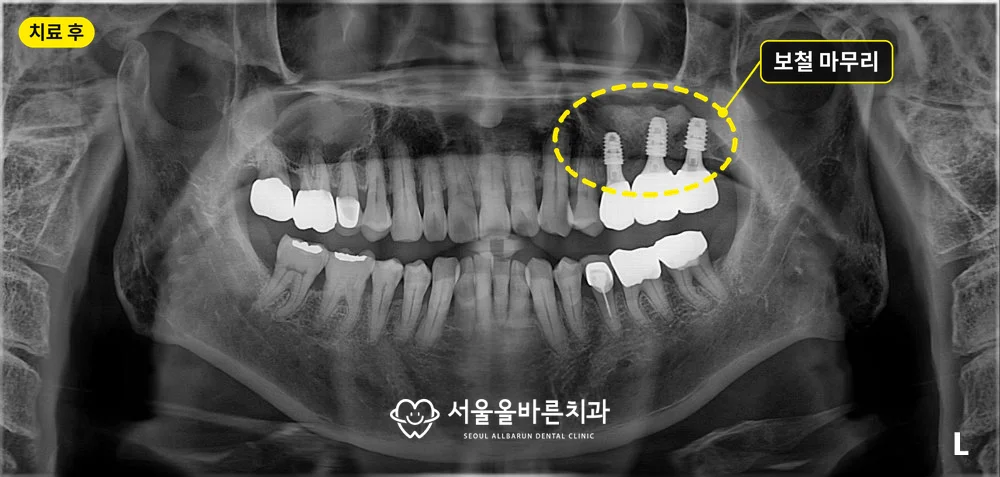 치료 후 파노라마, 위 왼쪽 어금니 임플란트 세 개에 연결 보철을 올린 모습