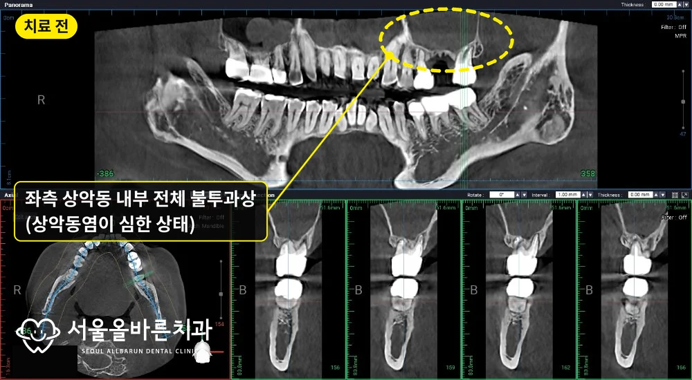 치료 전 CT, 왼쪽 상악동 내부 전체가 하얗게 보이는 불투과상