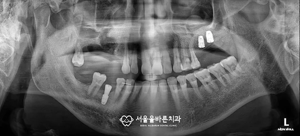 단계별 수술 과정