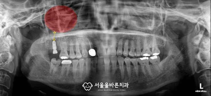 치조골의 높이가 확보되면서 매식체를 충분히 깊이 심을 수 있었습니다