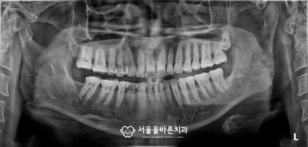 2026년 7월, 발치 7년 후 파노라마 엑스레이
