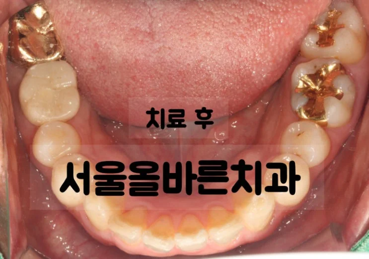 구리 어금니 임플란트, 염증 때문에 까다로운 케이스 - 치료 결과