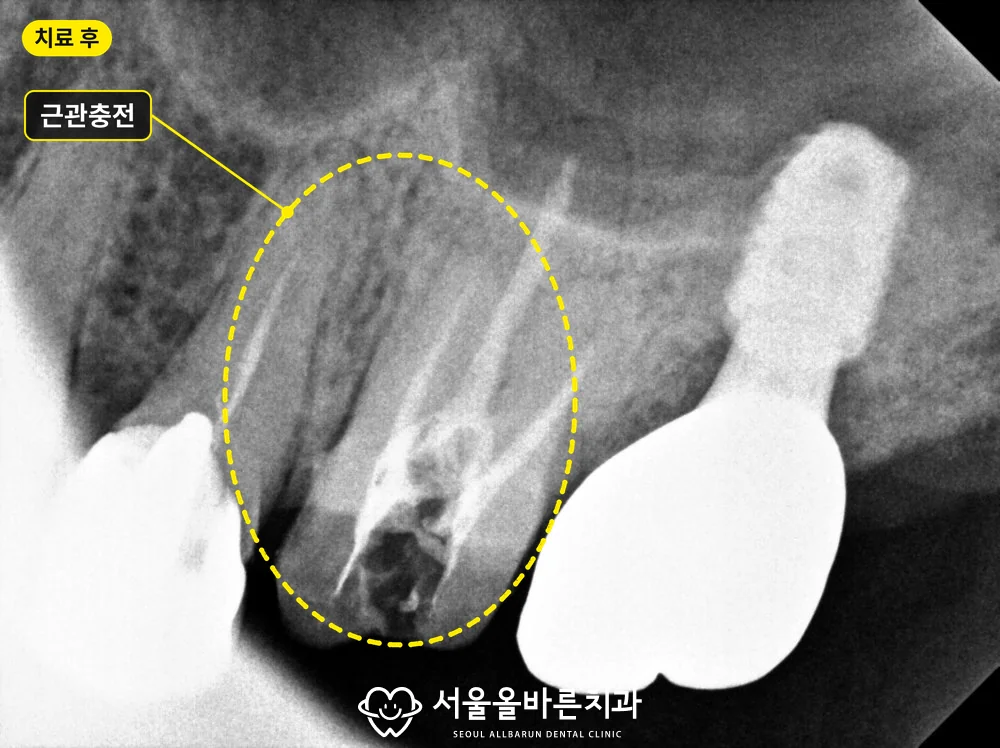 근관충전을 마친 뒤의 엑스레이