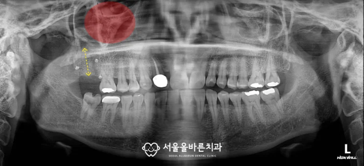 발치 직후 뼈이식 완료 상태 상악동과의 거리가 충분히 멀어졌습니다