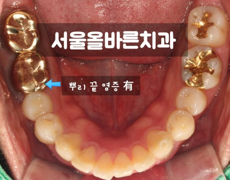 구리 어금니 임플란트, 염증 때문에 까다로운 케이스 - 초기 진단