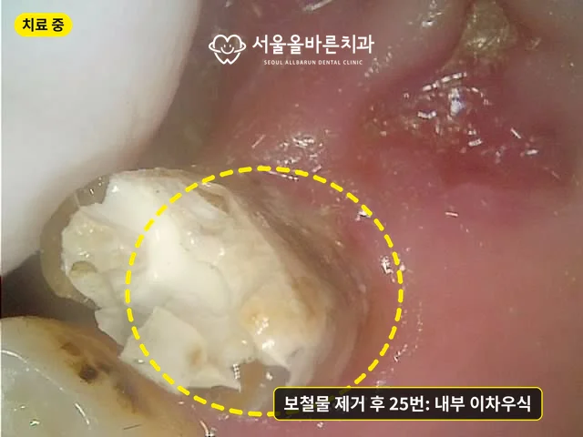 보철물을 제거한 25번 치아 내부의 이차우식