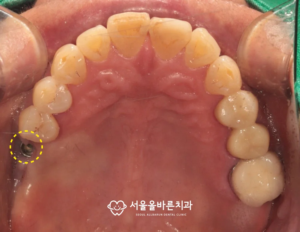 마지막 픽스처를 제거하기 전 구강 사진