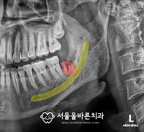 확대 사진, 남아 있는 사랑니(빨간색)와 하치조신경관(노란색)
