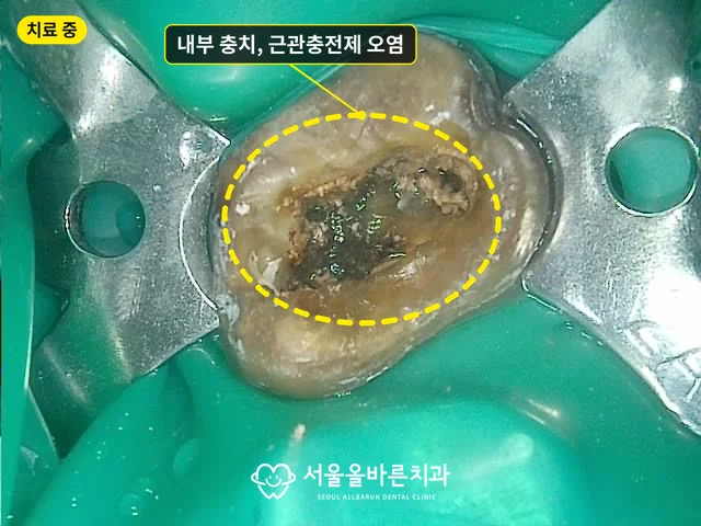 치료 중 구강 사진, 치아 내부의 충치와 오염된 근관충전제