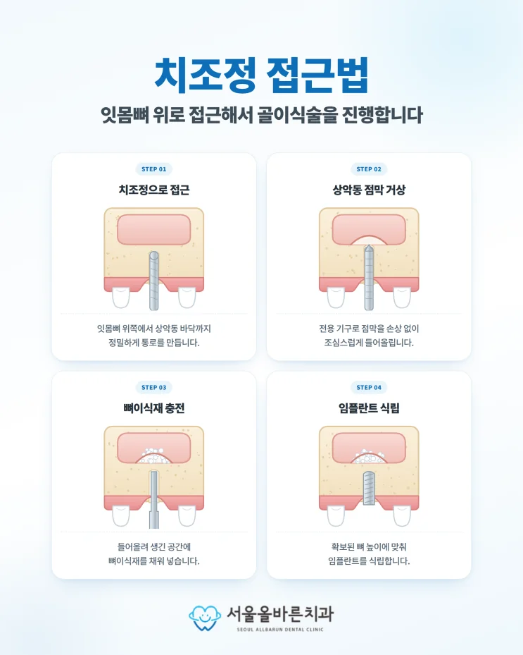 구리 어금니 임플란트, 치과 전문의가 생각하는 중요한 점 - 상악동거상술은 왜 할까요?