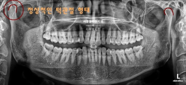 정상적인 형태의 턱관절