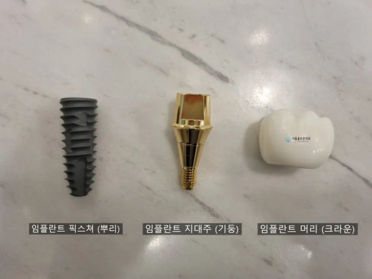 임플란트의 구조> 뿌리를 먼저 심고, 기둥을 세워 크라운을 연결합니다